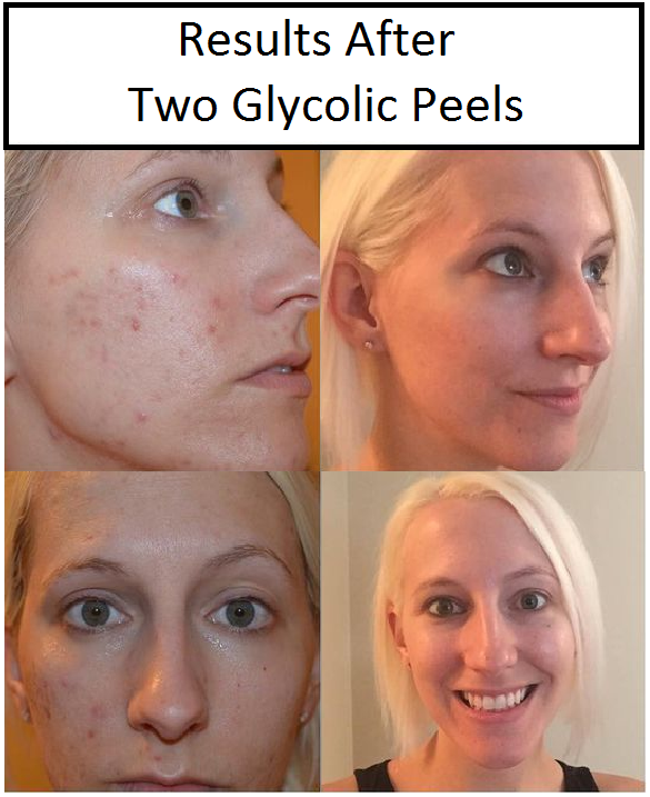 Gasoline reccomend Facial peels with glycolic acid