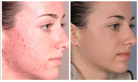 Z reccomend Facial peels with glycolic acid