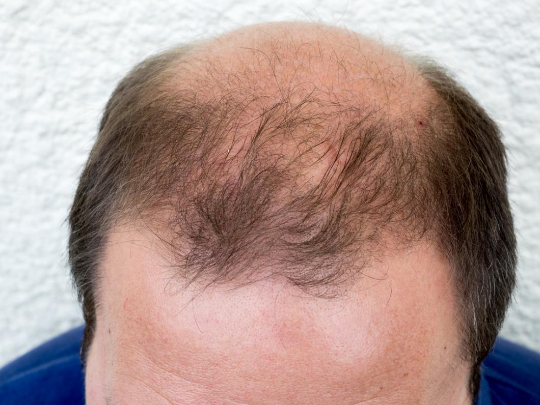 Facial and scalp hair loss